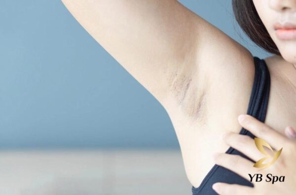 Nách bị thâm có thể do hiện tượng kích ứng da (Nguồn: Internet)