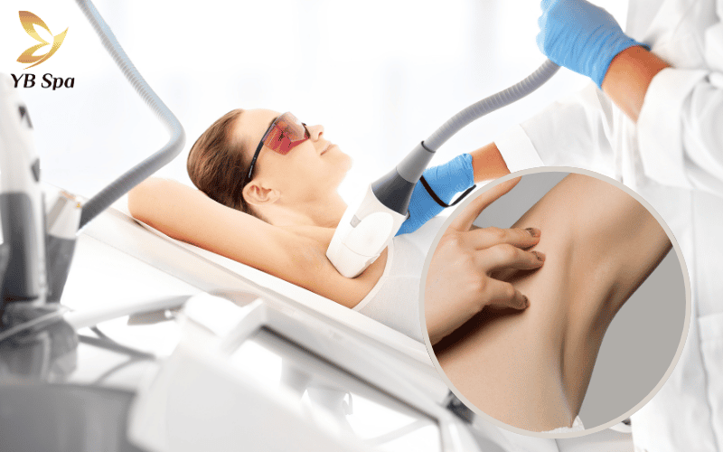 triệt lông nách có hết thâm không Không chỉ sạch vi-ô-lông, công nghệ triệt lông hiện đại còn hỗ trợ tái tạo làn da, đánh bay các hắc tố gây thâm sạm