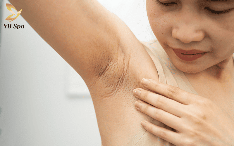 Tác động thô bạo khi nhổ, cạo là "thủ phạm" trực tiếp gây viêm lỗ chân lông và khiến bề mặt da sần sùi như da gà