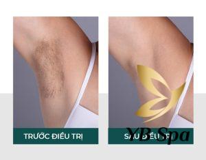 Triệt lông nách nên kiêng những gì?