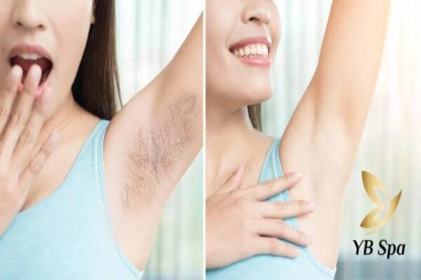 Triệt lông nách tuổi dậy thì tại spa khiến bạn tự tin (Nguồn: YB Spa)