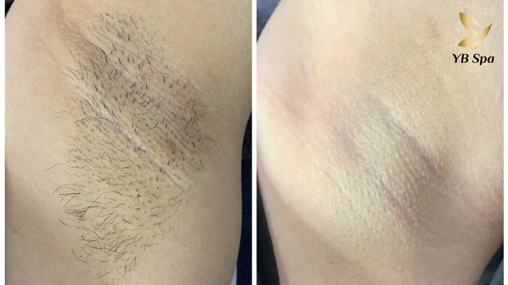 nách sạch lông sau khi triệt lông tại YB Spa