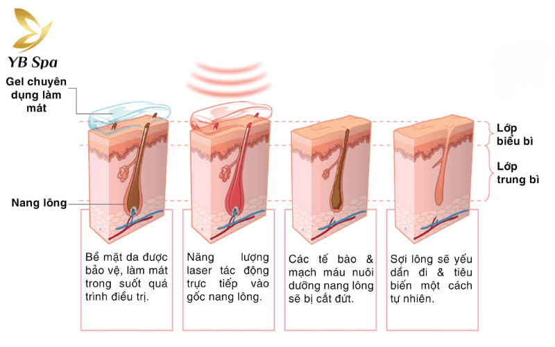 Triệt lông bằng laser là quá trình dùng ánh sáng để vô hiệu hóa các mạch máu nuôi dưỡng nang lông, ngăn chặn sợi lông mọc lại từ sâu bên trong