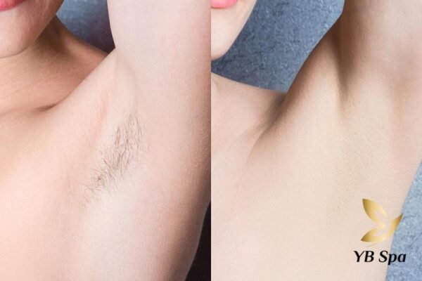 Kết quả triệt lông nách vĩnh viễn bằng laser (Nguồn: Internet)