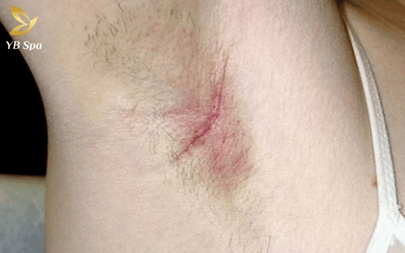 An toàn là trên hết: Chỉ nên can thiệp công nghệ laser khi các vết trầy xước ở vùng da nách đã lành lặn hoàn toàn