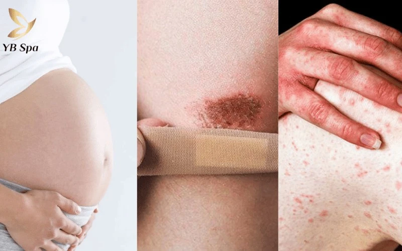 Phụ nữ mang thai hoặc người bị viêm da cấp tính cần tham khảo ý kiến bác sĩ trước khi triệt.