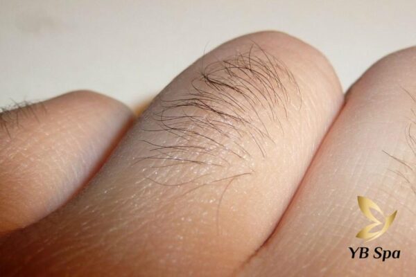 triệt lông ngón tay