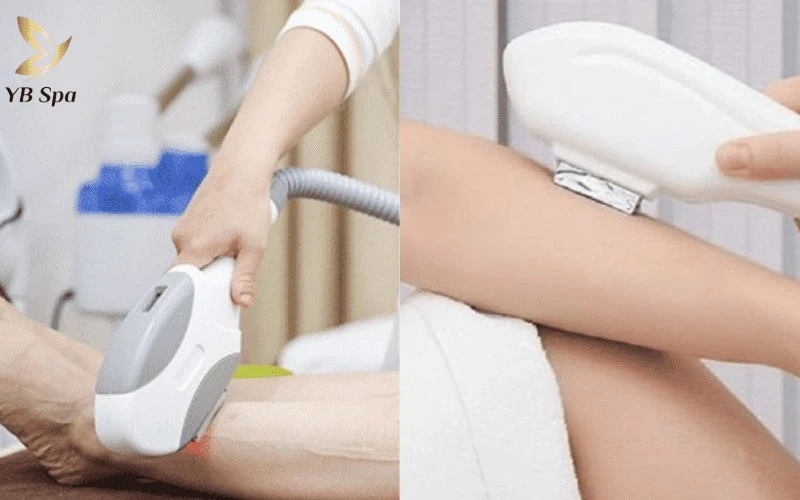 So sánh công nghệ triệt lông OPT và Diode Laser