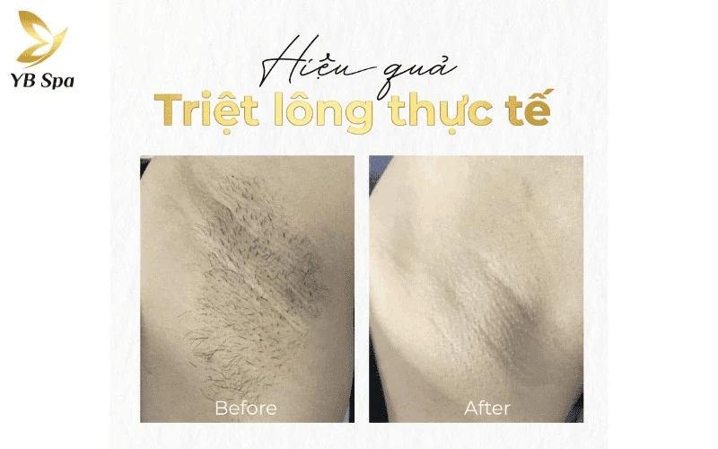 Top 5 Địa Chỉ Triệt Lông Quận 3 Uy Tín, Hiện Đại 12 Ngay sau liệu trình đầu tiên, bạn có thể cảm nhận lượng lông giảm đến 30% và sợi lông mọc lại cũng mảnh, thưa hơn