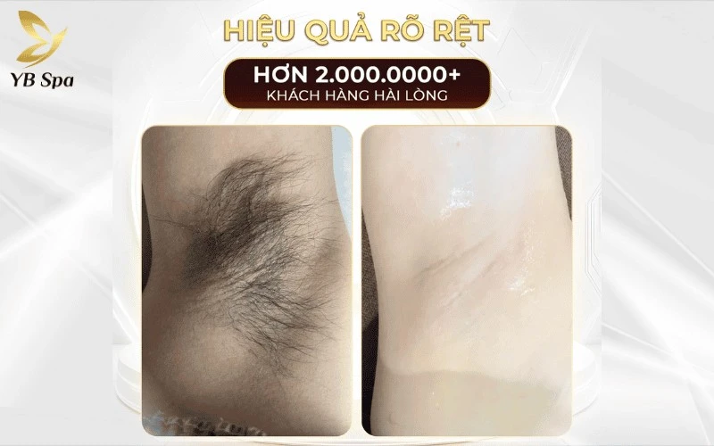 Trải nghiệm thực tế ghi nhận kết quả tích cực về cả độ sạch lông lẫn khả năng trẻ hóa da ngay từ những liệu trình đầu tiên