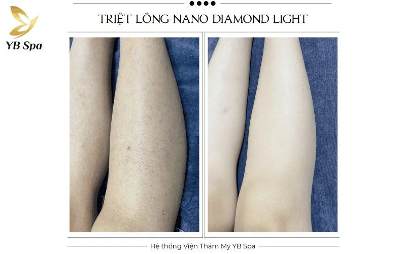 Hiệu quả triệt lông được ghi nhận rõ rệt chỉ sau 3 buổi với tình trạng lông mọc lại thưa mỏng và vùng da thâm sạm được cải thiện đáng kể