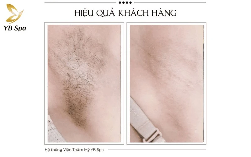 Sự kết hợp giữa kỹ thuật đi máy chuyên nghiệp và khả năng làm sáng da sau điều trị giúp YB Spa nhận được nhiều phản hồi tích cực về trải nghiệm dịch vụ.