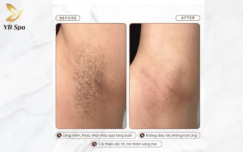 Chỉ sau từ 3 đến 4 buổi liệu trình, người dùng có thể nhận thấy rõ rệt tình trạng lông mọc lại thưa hơn, sợi mảnh và nhạt màu đi đáng kể