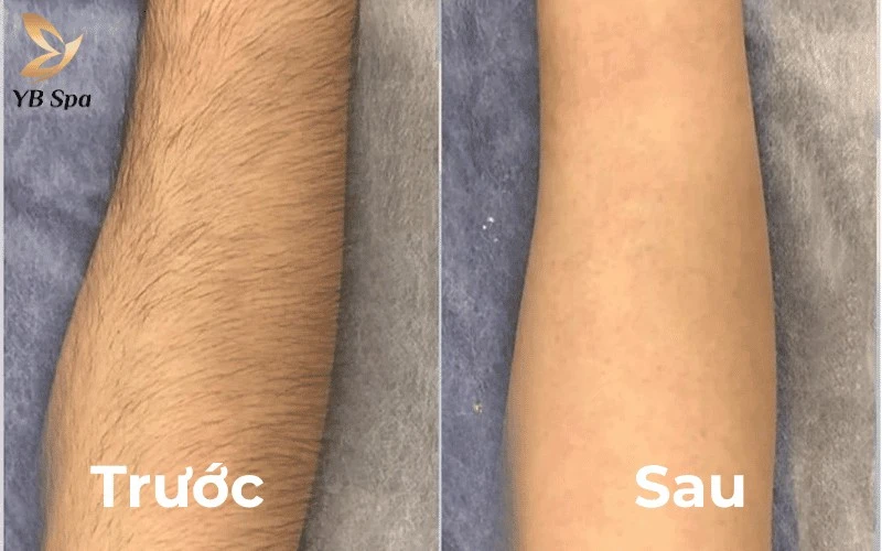 Vừa sạch lông vừa sáng da, liệu trình tại đây mang lại sự tự tin gấp bội cho phái đẹp với đôi tay mịn màng