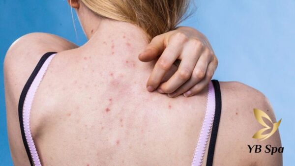 Triệt lông vĩnh viễn có chữa được viêm nang lông không? (Nguồn: Internet)