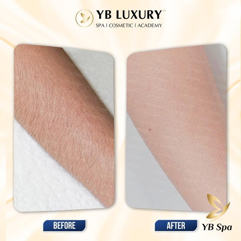 Triệt Lông Vĩnh Viễn Có Đau Không? Cần Lưu Ý Gì Khi Triệt Lông? 23 Hình ảnh khách triệt lông tại YB Spa (Nguồn: YB Spa)