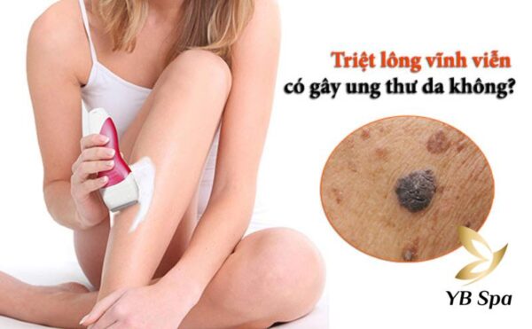 Bạn lo lắng khi triệt lông vĩnh viễn gây ung thư da (Nguồn: Internet)