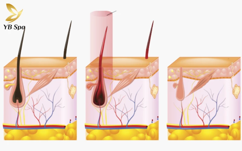 Triệt lông vùng kín bằng laser là gì? Có gây đau rát không? 22 Triệt lông vùng kín bằng laser là quá trình chuyển hóa ánh sáng thành nhiệt năng để "vô hiệu hóa" nang lông.