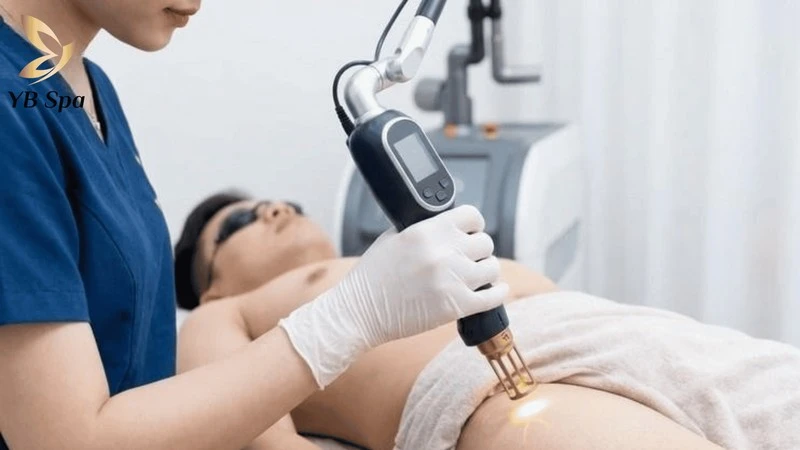 Công nghệ laser hiện đại giúp triệt lông bikini nam vĩnh viễn, an toàn và hạn chế tối đa tổn thương da.