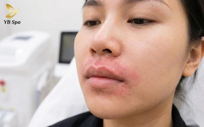 Tình trạng mẩn đỏ nhẹ là phản ứng tự nhiên của da và thường biến mất sau vài giờ.