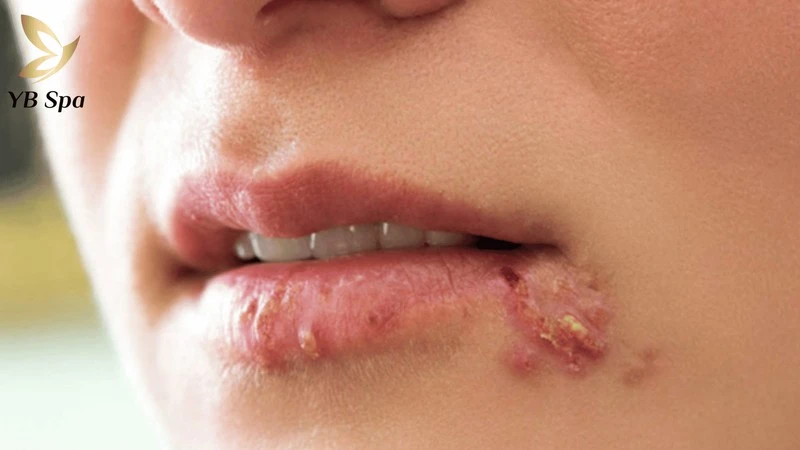 Tuyệt đối không triệt ria mép khi vùng da quanh mép đang có mụn viêm hoặc vết cắt do dao cạo để tránh nhiễm trùng sâu.