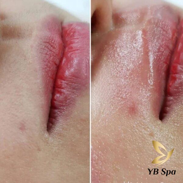 Triệt ria mép công nghệ vĩnh viễn tại YB Spa