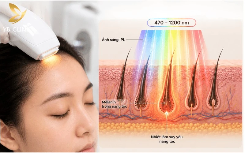 Top 5 Phương Pháp Triệt Tóc Con Vùng Trán Phổ Biến 8 Công nghệ IPL sử dụng ánh sáng xung đa phổ tác động vào nang tóc, giúp làm yếu tóc con và hỗ trợ da trán sáng hơn.
