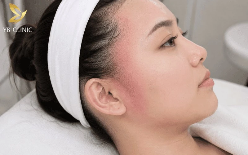 Triệt Tóc Mai Cho Nam Nữ Có Nên Không? Lợi Ích Và Rủi Ro Tiềm Ẩn 11 Đỏ da và châm chích nhẹ sau triệt là phản ứng tạm thời, thường giảm nhanh khi được chăm sóc và làm dịu đúng cách.
