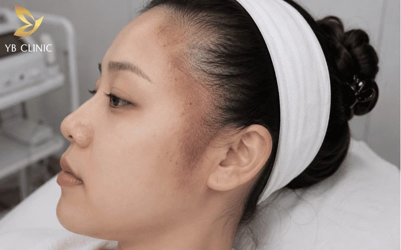 Triệt Tóc Mai Cho Nam Nữ Có Nên Không? Lợi Ích Và Rủi Ro Tiềm Ẩn 12 Tăng sắc tố sau triệt có thể xảy ra nếu da không được bảo vệ đúng cách khỏi tác động của tia UV.