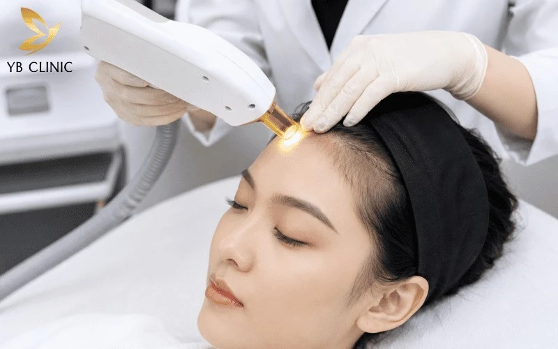 Triệt Tóc Trán Là Gì? Có Nên Triệt Tóc Trán Không? 9 Triệt tóc trán là phương pháp thẩm mỹ sử dụng ánh sáng hoặc laser để tác động vào nang tóc, giúp loại bỏ vùng tóc mọc lệch và tạo đường chân tóc gọn gàng hơn.