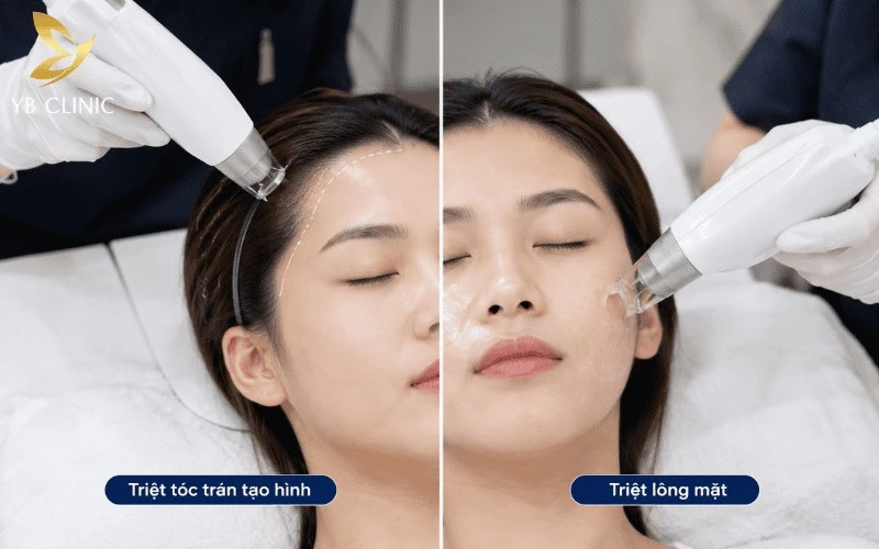 Triệt Tóc Trán Giá Bao Nhiêu? Bảng Giá Và Yếu Tố Ảnh Hưởng 7 Triệt tóc trán tạo hình khác biệt với triệt lông mặt nhờ khả năng thiết kế đường chân tóc hài hòa, chuẩn thẩm mỹ.