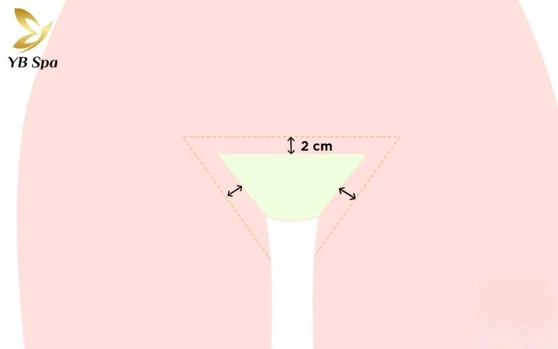 Triệt lông bikini bao nhiêu tiền? Bao nhiêu buổi mới sạch?