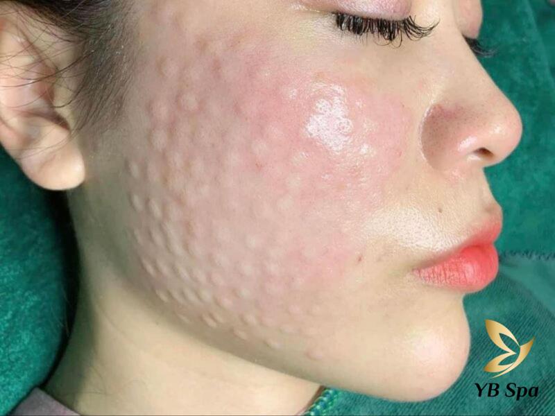 U hạt sau meso là gì? Nguyên nhân và cách trị dứt điểm 5 U hạt sau Meso, là tình trạng da xuất hiện những hạt nhỏ tại các vị trí meso.