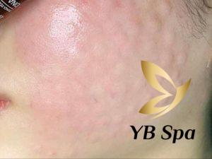 U hạt sau meso là gì? Nguyên nhân và cách trị dứt điểm