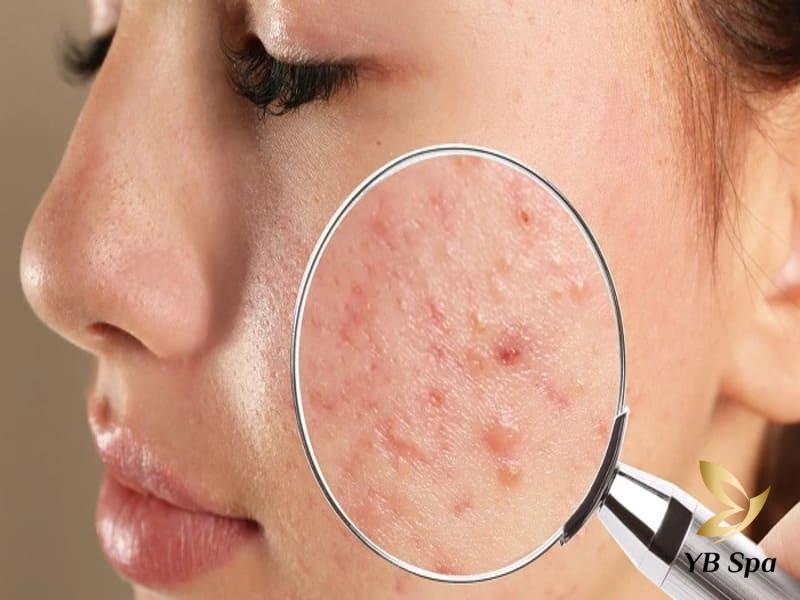 Uống cà phê có nổi mụn không? Cách uống cà phê không nổi mụn 26 cô gái da bị mụn khi uống cà phê