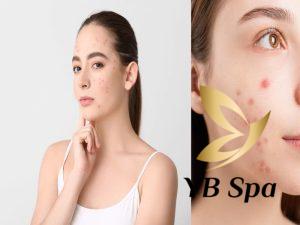 Nên uống gì cho mát gan hết mụn hiệu quả?