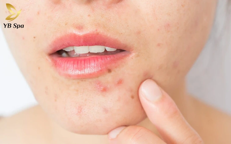 Mụn nội tiết thường tập trung ở vùng cằm