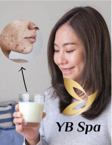 Uống sữa có nổi mụn không? Các loại sữa nên uống khi bị mụn