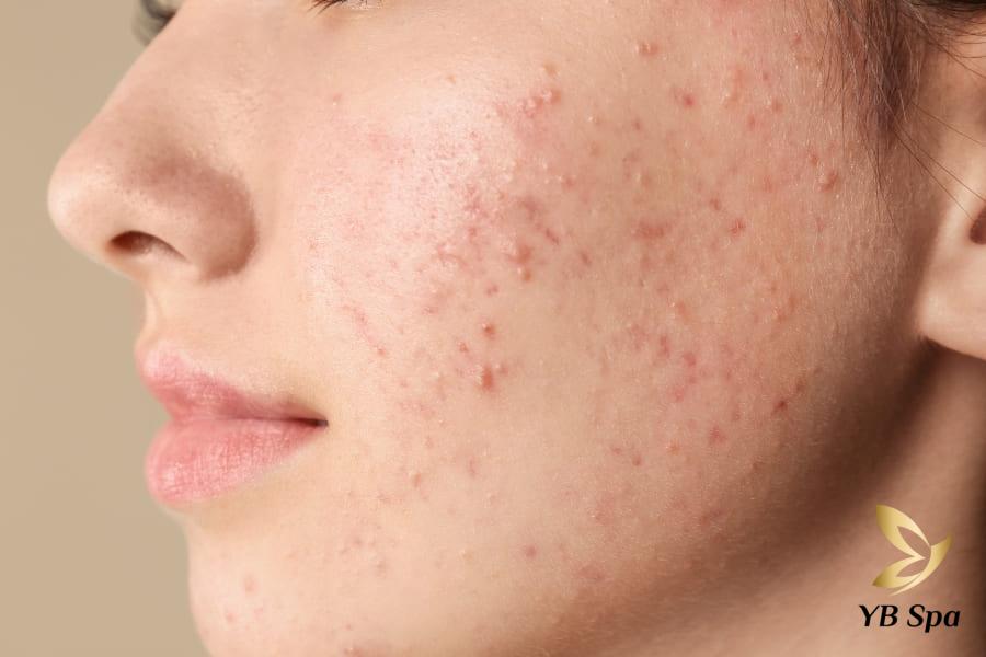 Các vị trí mụn trên mặt của bạn nói lên điều gì về sức khỏe? 27 Hai bên má là khu vực dễ bị mụn nhất và thường do cả tác động từ môi trường lẫn những vấn đề bên trong cơ thể.
