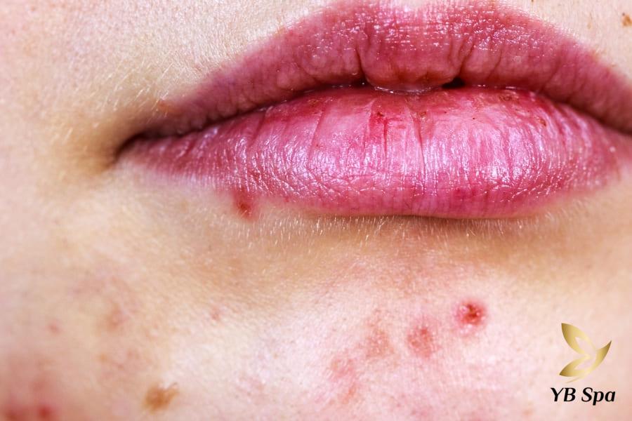 Các vị trí mụn trên mặt của bạn nói lên điều gì về sức khỏe? 28 Mụn xuất hiện ở vị trí này thường gắn liền với chức năng hoạt động của ruột và gan.