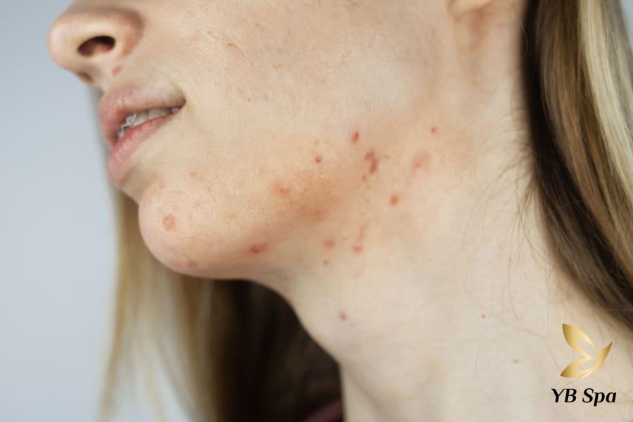 Các vị trí mụn trên mặt của bạn nói lên điều gì về sức khỏe? 31 Mụn xuất hiện riêng lẻ hoặc theo từng cụm ở vùng hàm dưới thường phản ánh thói quen ăn uống không lành mạnh