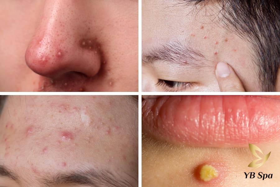Các vị trí mụn trên mặt của bạn nói lên điều gì về sức khỏe? 32 vị trí nổi mụn có nguy cơ cao là đáng lo ngại là vùng mũi, chân mày, thái dương và quanh miệng.