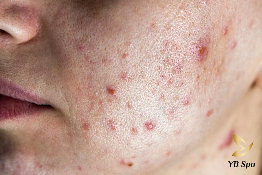 Các vị trí mụn trên mặt của bạn nói lên điều gì về sức khỏe? 33 Đây có thể là dấu hiệu cảnh báo của dị ứng, kích ứng da, hoặc các vấn đề da liễu nghiêm trọng khác.