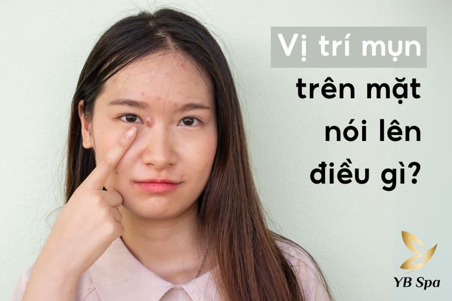 Các vị trí mụn trên mặt của bạn nói lên điều gì về sức khỏe?