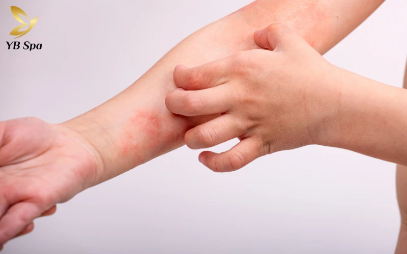 Viêm da cơ địa là bệnh gì? Triệu chứng, nguyên nhân và cách điều trị phù hợp 23 Viêm da da cơ địa là bệnh gì? Triệu chứng, nguyên nhân và cách điều trị phù hợp