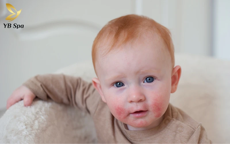 Viêm da cơ địa là bệnh gì? Triệu chứng, nguyên nhân và cách điều trị phù hợp 26 Triệu chứng nhận biết viêm da cơ địa