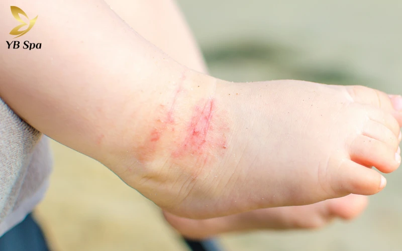 Viêm da cơ địa là bệnh gì? Triệu chứng, nguyên nhân và cách điều trị phù hợp 27 Nguyên nhân gây viêm da cơ địa