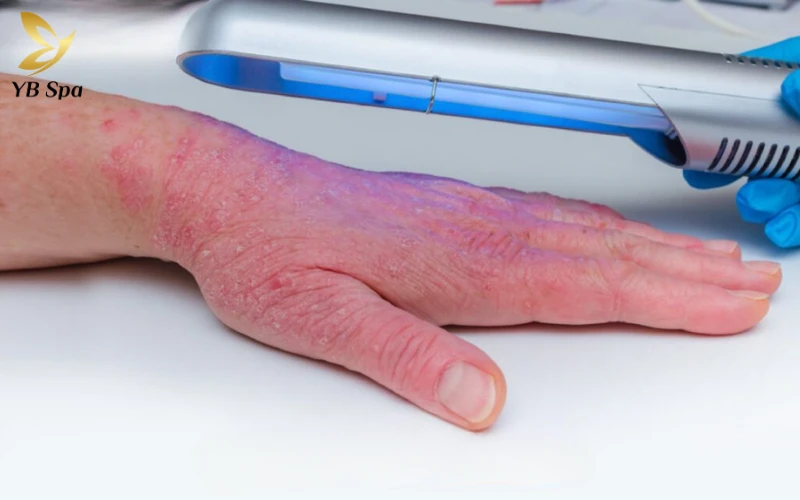 Viêm da cơ địa là bệnh gì? Triệu chứng, nguyên nhân và cách điều trị phù hợp 30 Quang trị liệu (Phototherapy)