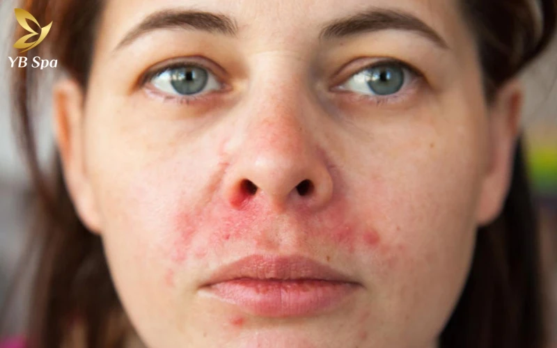 Viêm da tiết bã là gì