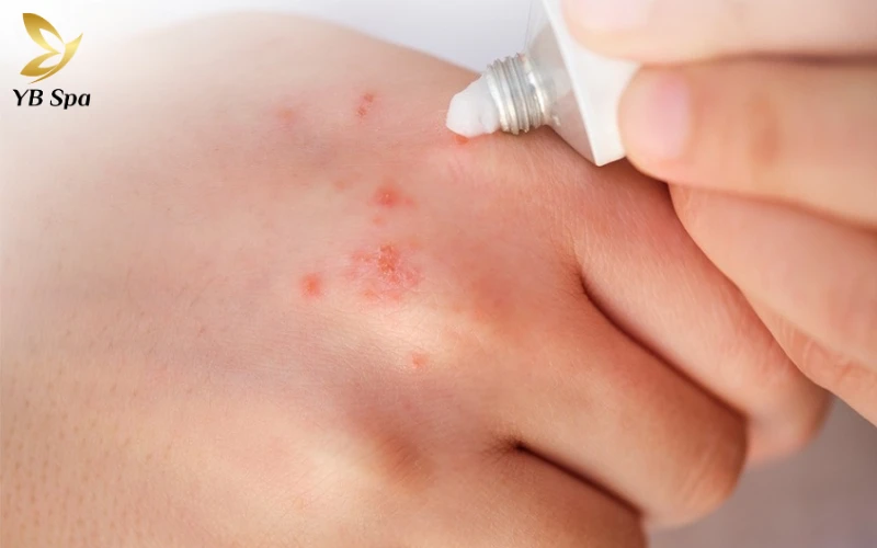 Corticosteroid Bôi (dùng Ngắn Hạn)